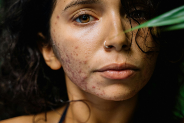 Como Tratar e Prevenir Acne Causada por Maquiagem: Dicas, Produtos e Técnicas para Cuidar da Sua Pele